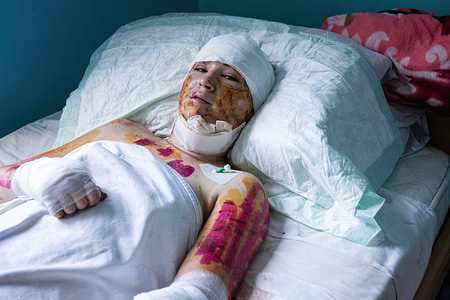 (EDITORS NOTE Image contains graphic content) A girl wounded by a Russian rocket attack on a shopping centre lies on a bed in a city hospital in Kremenchuk. Russian troops launched a missile attack on a shopping mall in central Kremenchuk.