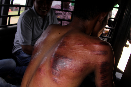 A man is seen with a bruised back after being flogged in public.
Aceh is the only province in Indonesia that publically flogs people for violating the Islamic sharia law, in 2017 to 2018 65 people were sentenced to whips.