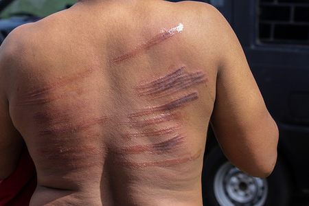 A convicted person seen with wounds after being sentenced to whips for violating the Islamic Sharia law.
Although considered to violate the International Convention against Cruel, Inhuman or Torture and Cruelty. Aceh, one of the provinces in Indonesia that insists on carrying out whipping as a province of Islamic Sharia law.