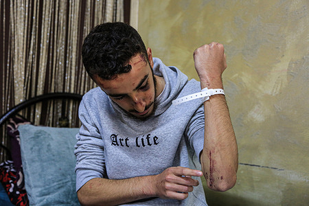 Palestinian youth, Muhammad Owaisat (17), points out some of the injuries he sustained after he was beaten by Israeli soldiers. The Owaisat family alleged that Mohammed was beaten by the Israeli soldiers and then placed in the hospital without informing them. After hours of searching for him, he was found in Hadassah Hospital in Jerusalem with a broken nose and bruises over his head and back.