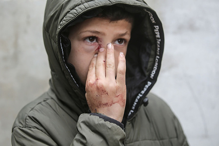 A Palestinian wounded child seen with an eye injury after the attack. Four members of the Awda family were killed inside their car after Israeli forces opened fire on their vehicle during a military operation in Tammun. Local residents reported that Israeli forces killed four members of a Palestinian family. Tammou falls under the jurisdiction of the Palestinian Authority headed by President Mahmoud Abbas.