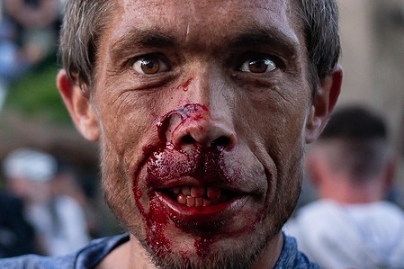 (EDITORS NOTE: Image contains graphic content) 
A man is seen with a bloodied face as violent clashes erupt as protesters gather to express their anger at the murder of Henry Nowak following the release of police bodycam footage which shows Nowak handcuffed and arrested whilst telling police he had been stabbed and couldn’t breathe. Vickrum Digwa, was jailed for Nowak's murder and was sentenced to life in prison. Digwa had lied to police at the scene, stating he had been the victim of a racist attack.