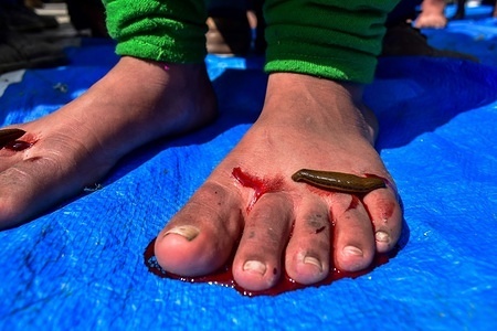(EDITORS NOTE: Image contains graphic content.)
A patient seen bleeding during the leech therapy.
Every year traditional health workers in Kashmir use leeches to treat people suffering from skin diseases, arthritis, chronic headaches and sinusitis on Nowruz, which marks the first day of spring and the beginning of the year in the Persian calendar.