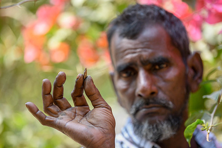 A Bangladesh civilian, Shamsul Alam 55 years old holds a bullet that was removed from his body after he was shot.
One of his married daughters lived close to the border where the shooting happened on Feb 4. He got scared for their safety and hurried to help them. While they were trying to get away, a Myanmar soldier shot him. Conflict with the Arakan Army, an armed rebel group inside Myanmar, continues unabated. Sustained firing, the sound of mortar shells bursting could be heard across the Bangladesh-Myanmar border area. Bullets and mortar shells fired from Myanmar are coming across the border in the towns of Bangladesh.